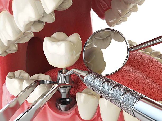 Best Chipped Tooth Repair Near Me  in Hobart, OK